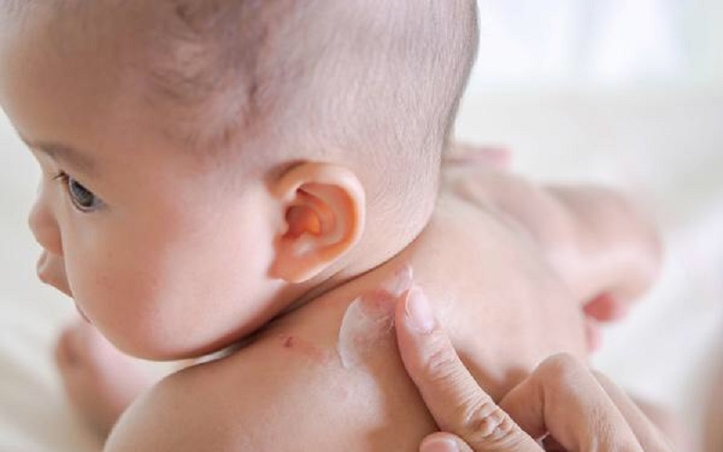 Hỗ trợ điều trị rôm sảy, làm lành vết thương do côn trùng đốt