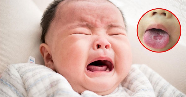 Các mảng bám màu trắng trên lưỡi của trẻ