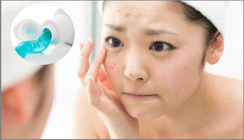 Hỗ trợ điều trị mụn trứng cá