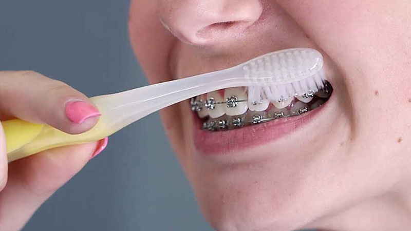 Vệ sinh răng miệng dành cho người niềng răng