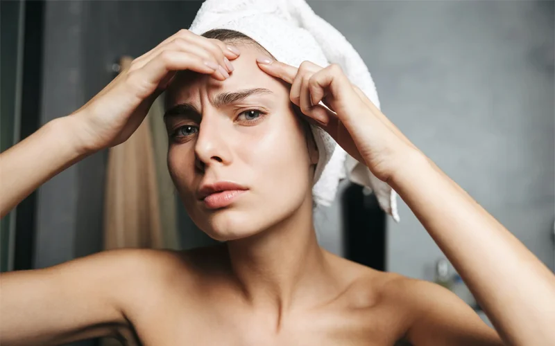 Nổi mụn khi đến kỳ kinh nguyệt